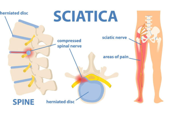 Say Goodbye to Sciatic Nerve Pain in Just 10 Minutes with This Natural Method