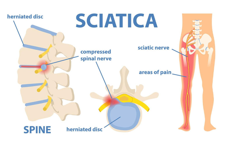 Say Goodbye to Sciatic Nerve Pain in Just 10 Minutes with This Natural Method